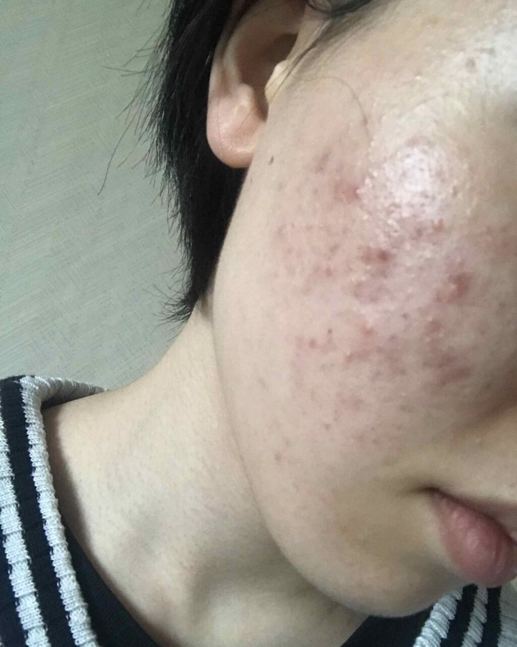 まるむすび on LIPS 「中学生から悩まされてきたこのニキビ達…ニキビ跡も最近増えてきて..」(2枚目)