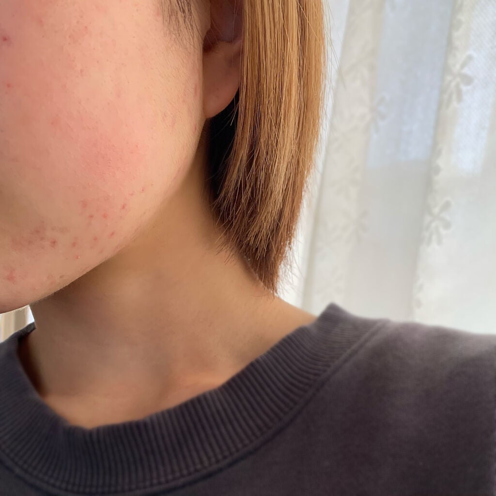 ゆる on LIPS 「※2枚目から肌の写真となります(自然光、外カメラ撮影)最初から..」(3枚目)