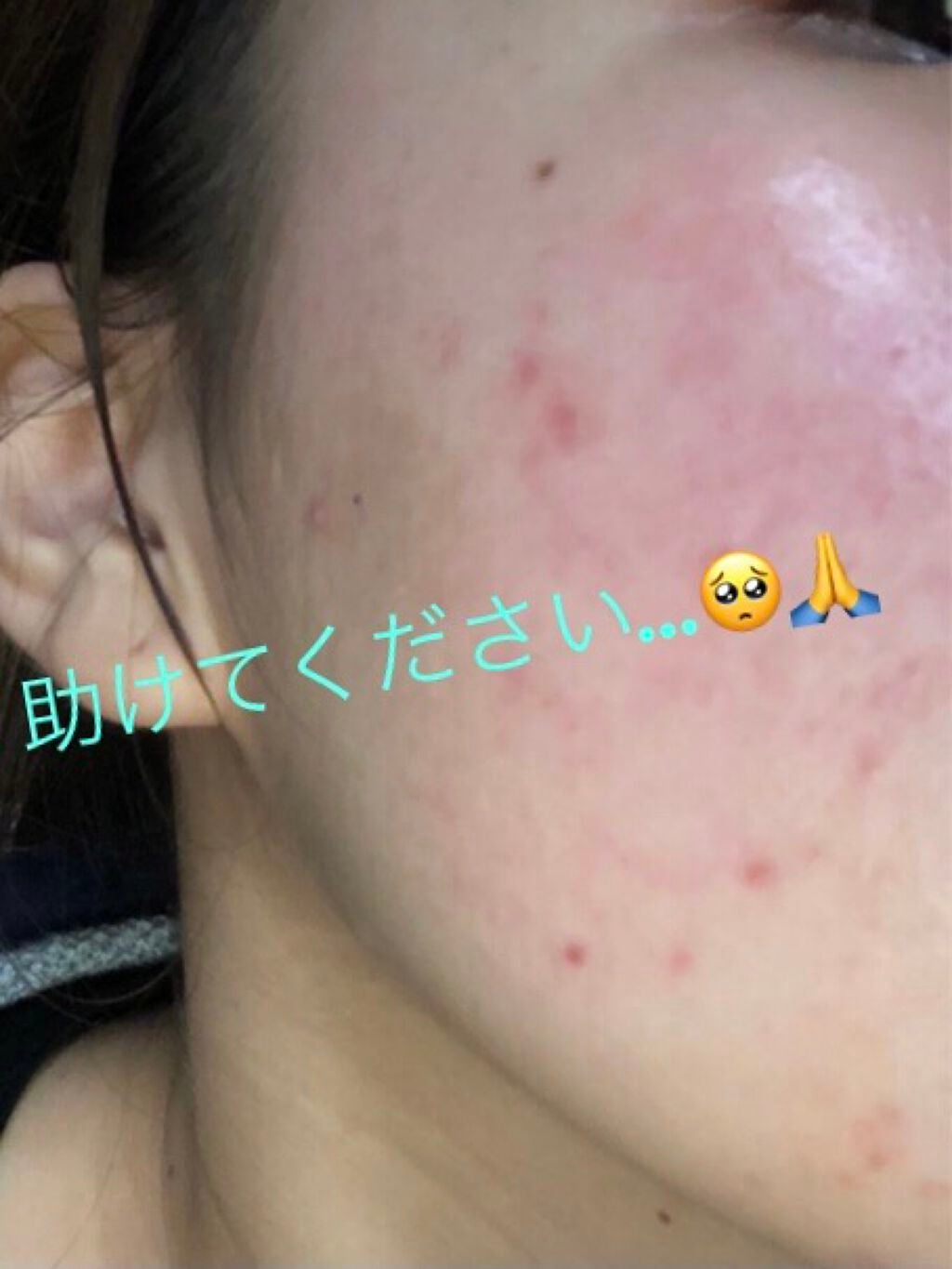 いずみ on LIPS 「どうか助けてください…🥺🙏ニキビとニキビ跡が酷くて、毎日鏡を見..」(1枚目)