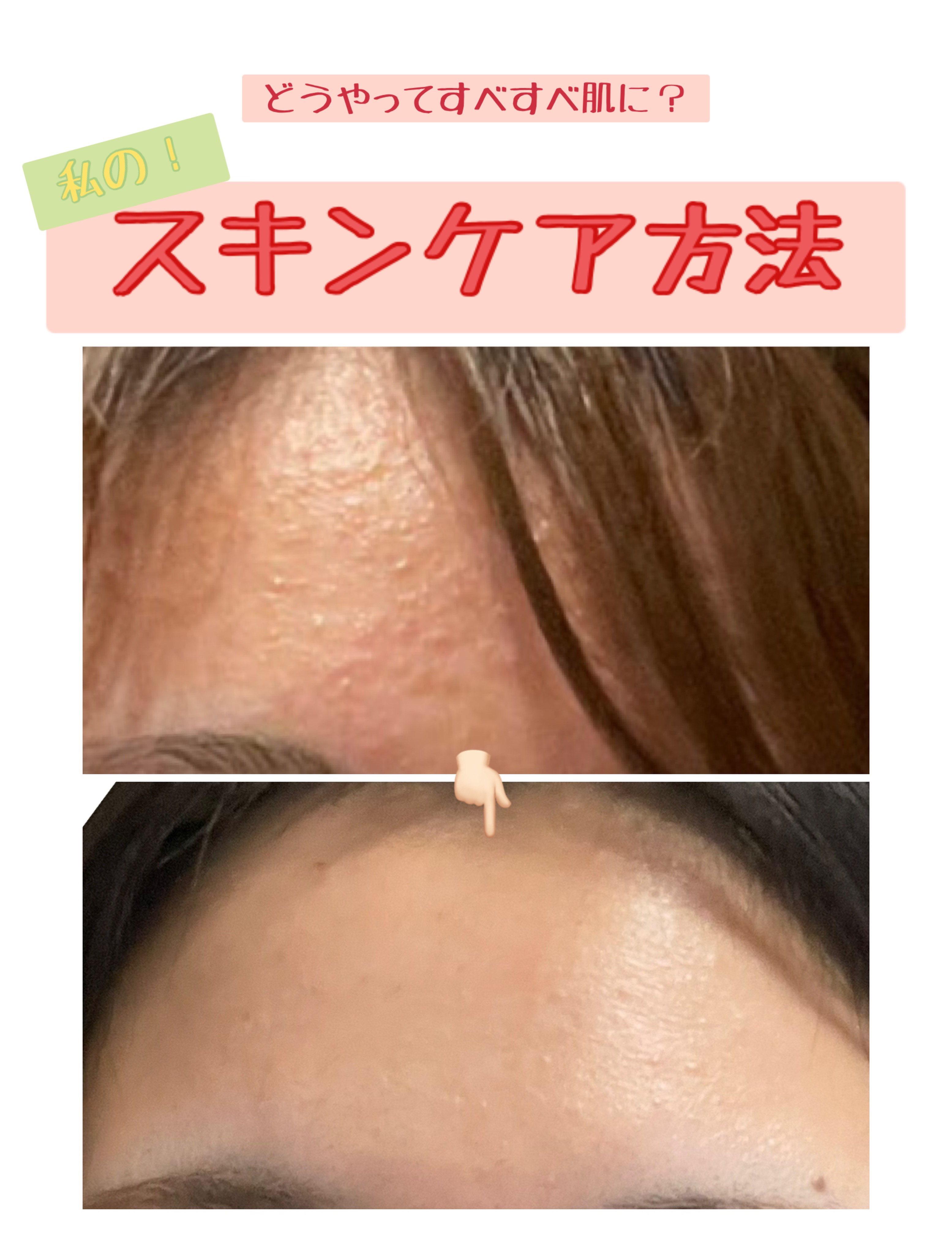 パーフェクトホイップ アクネケア/SENKA（専科）/洗顔フォームを使ったクチコミ（1枚目）