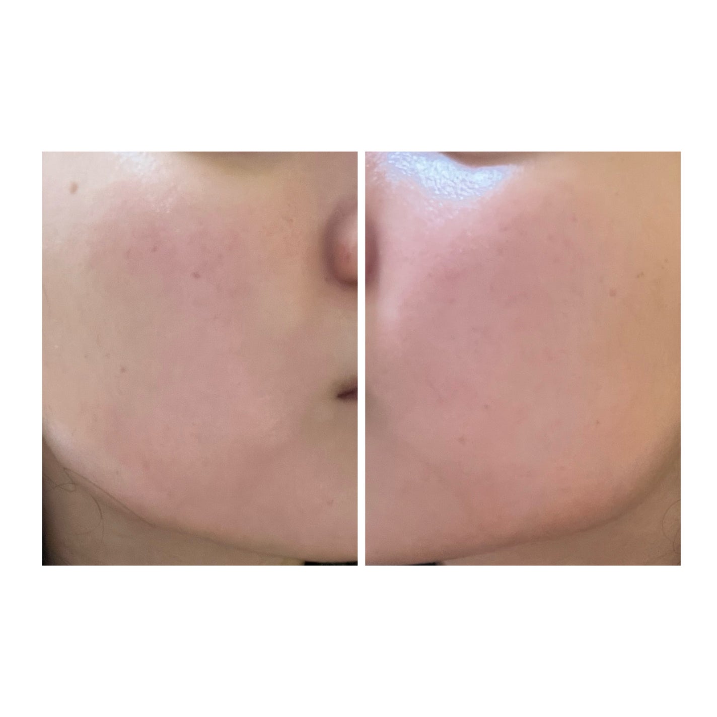 ぽむ on LIPS 「2023.9.13皮膚科に受診 エピデュオとヘパリン処方1枚目..」(3枚目)