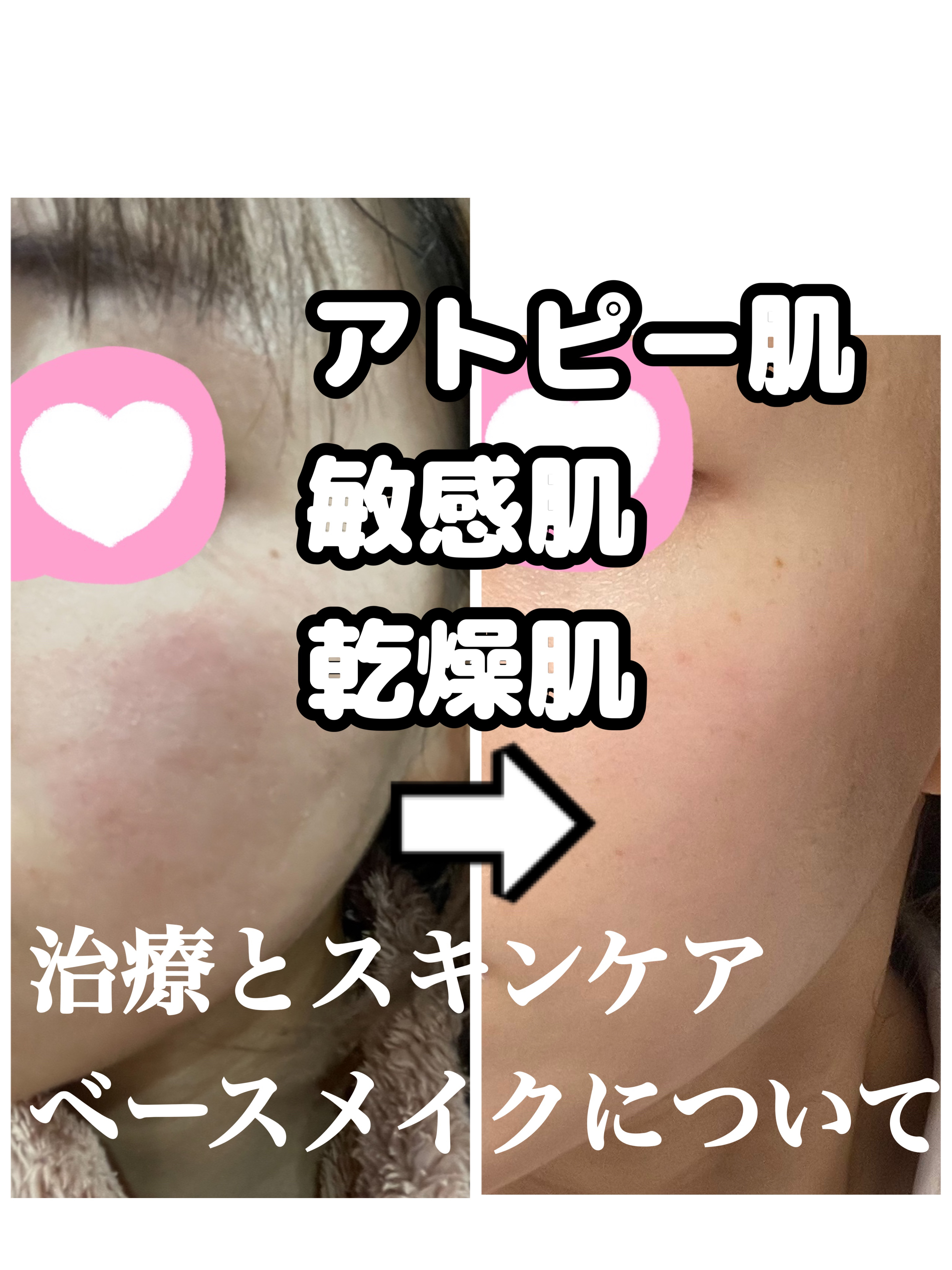 ヒルメナイド油性クリーム（医薬品）/matsukiyo/その他を使ったクチコミ（1枚目）