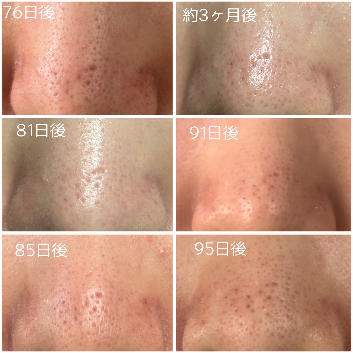 イチジク毛穴アンプル/Veganifect/美容液を使ったクチコミ(6枚目)