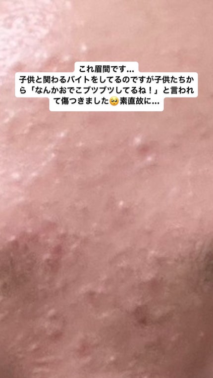 ニキビ治療薬(医薬品)/メンソレータム アクネス/その他を使ったクチコミ(6枚目)