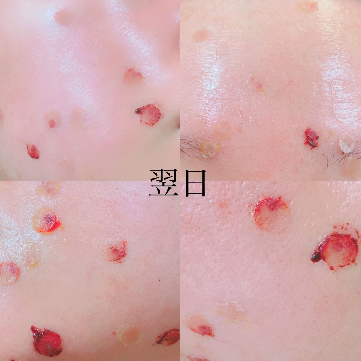 𝒂𝒓𝒊𝒔𝒂 on LIPS 「🤎意外と多いお悩み・・・?ホクロについて🤎医療レーザーでホクロ..」(3枚目)