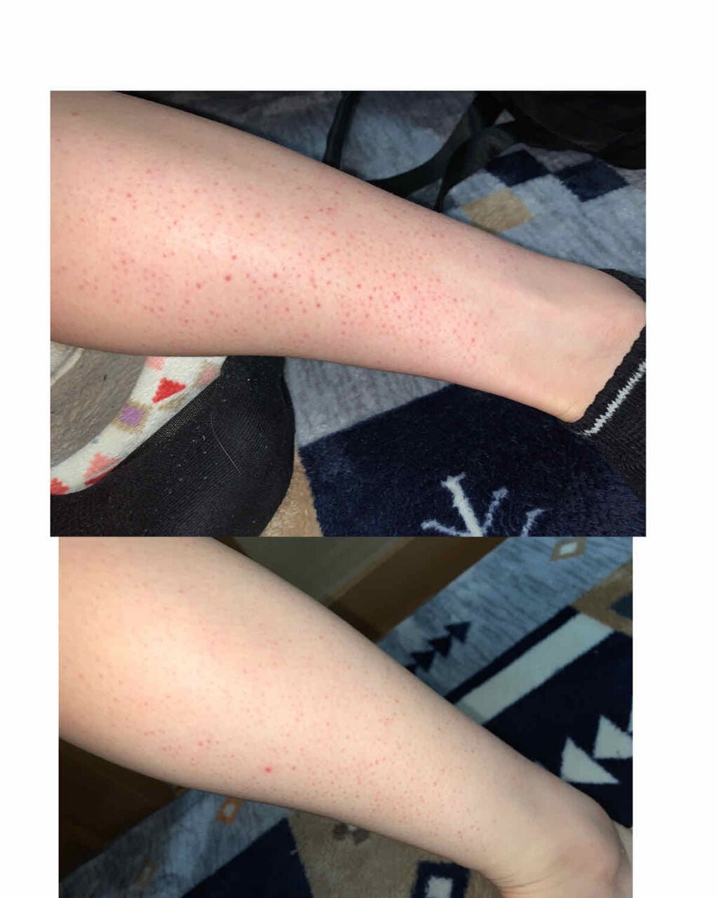 ケアノキュア(医薬品)/小林製薬/その他を使ったクチコミ(2枚目)