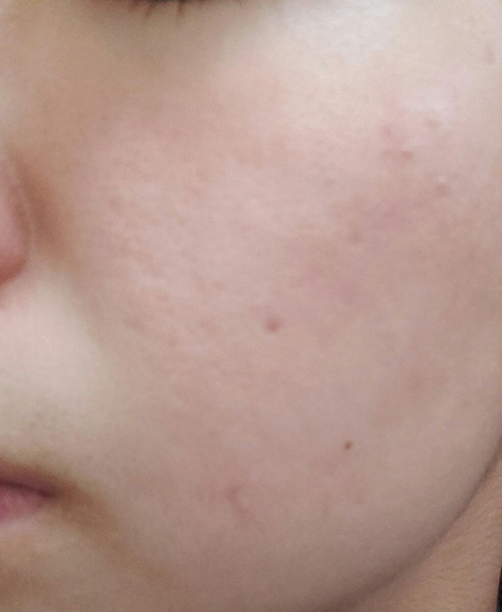 うさぎ on LIPS 「緊急です!!!!🚑🚑🚑このほっぺの赤みどうやったら消えますかね..」(2枚目)