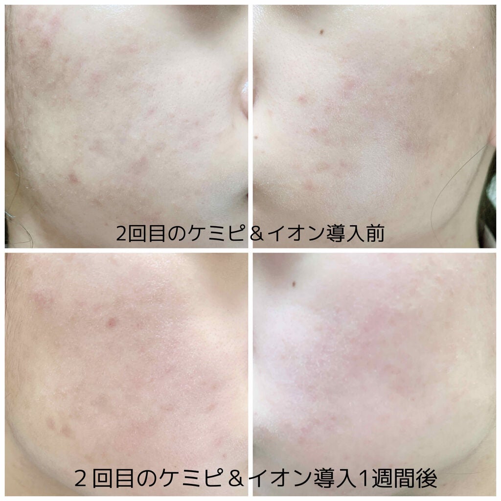 薬用 しみ 集中対策 美容液/メラノCC/美容液を使ったクチコミ(2枚目)