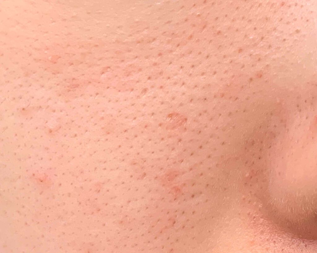 ぴっぴ on LIPS 「アイメイクから一転、またまた汚肌降臨致しました。ぴっぴと申しま..」(2枚目)