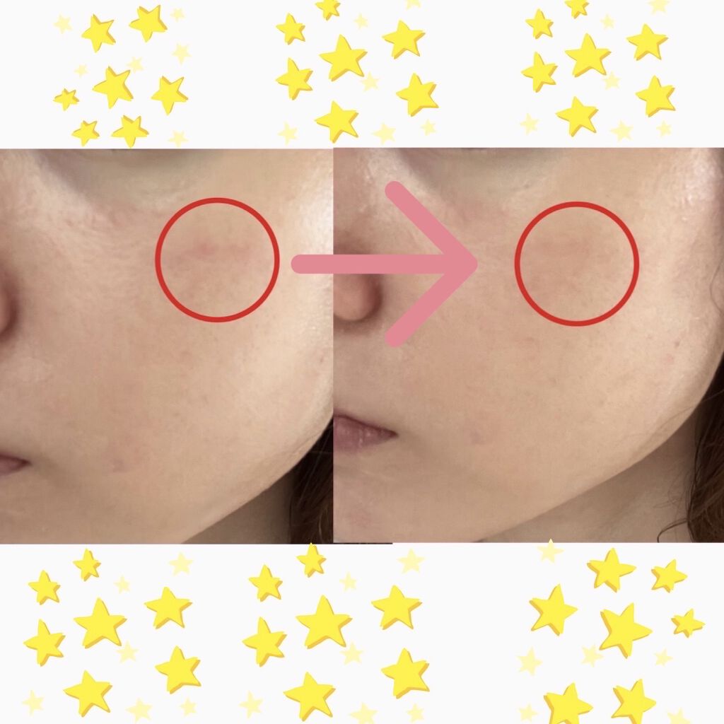 薬用ホワイトニングUVコンシーラー/トランシーノ/スティックコンシーラーを使ったクチコミ（2枚目）