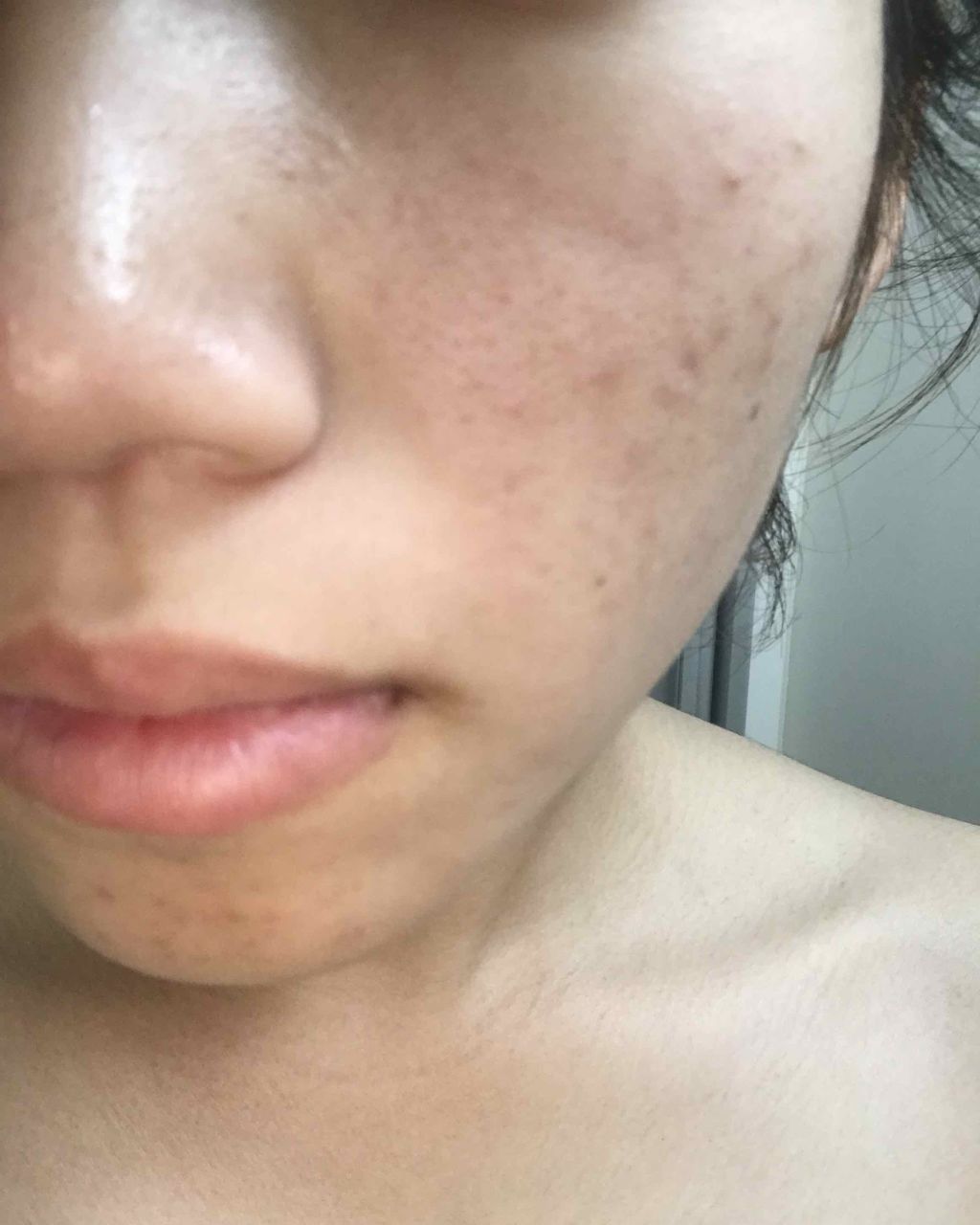 ディフェリンゲル0.1% /マルホ株式会社/その他を使ったクチコミ（3枚目）