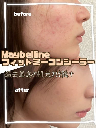 フィットミー コンシーラー/MAYBELLINE NEW YORK/リキッドコンシーラーを使ったクチコミ（1枚目）