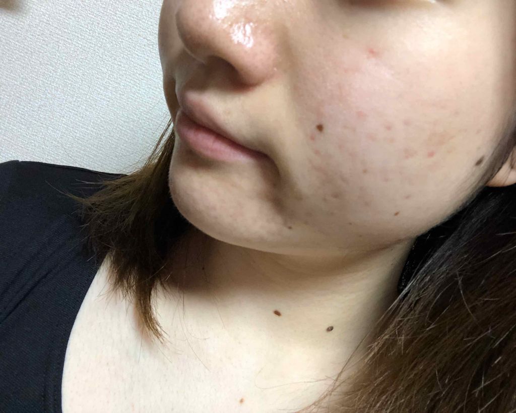 マンスリースキンケアプログラム(旧)/APEX/スキンケアキットを使ったクチコミ(4枚目)