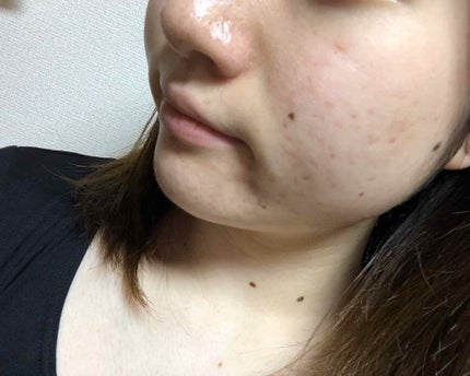 マンスリースキンケアプログラム(旧)/APEX/スキンケアキットを使ったクチコミ(4枚目)