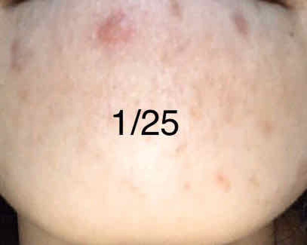 テラ・コートリル 軟膏(医薬品)/ジョンソン・エンド・ジョンソン/その他を使ったクチコミ（3枚目）