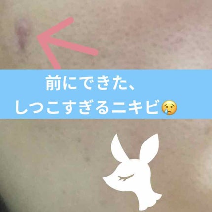 ACケア/ACROPASS/その他スキンケアを使ったクチコミ(4枚目)