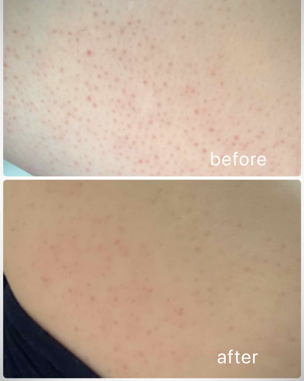 ニキビを防ぐ薬用石鹸 ForBack/ペリカン石鹸/ボディ石鹸を使ったクチコミ（2枚目）