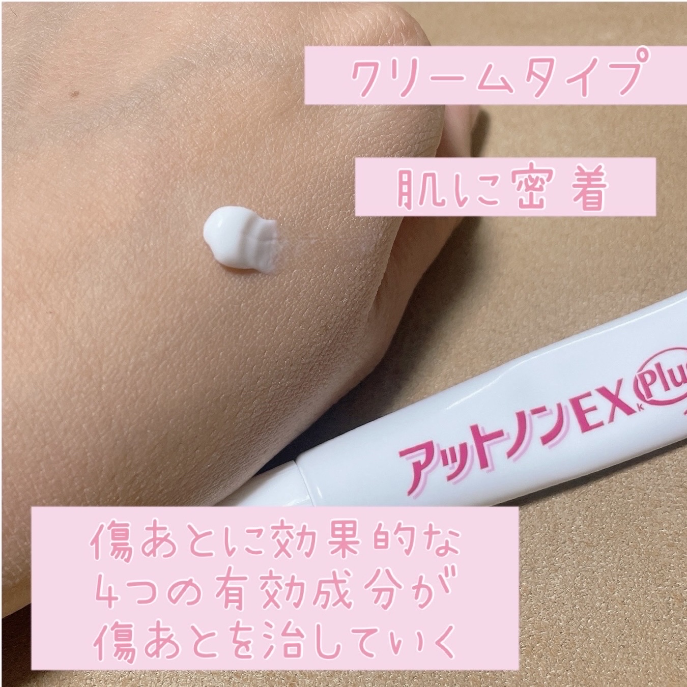 アットノンEX クリーム(医薬品)/アットノン/その他を使ったクチコミ（2枚目）