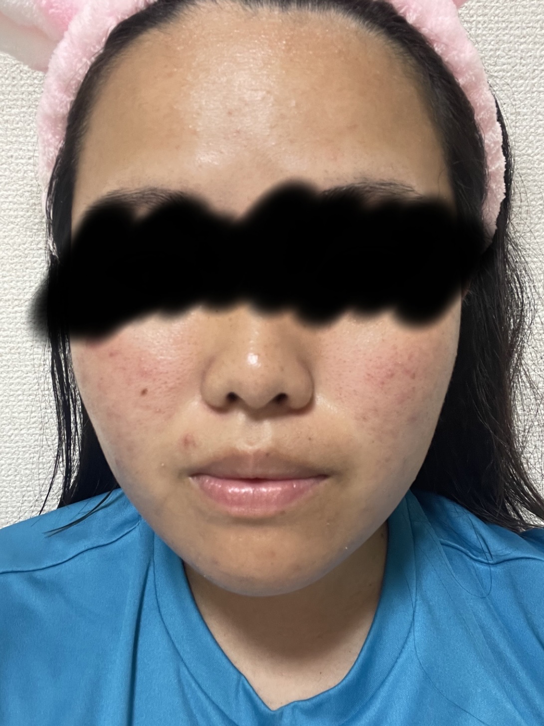 薬用 極潤 スキンコンディショナー/肌ラボ/化粧水を使ったクチコミ（2枚目）