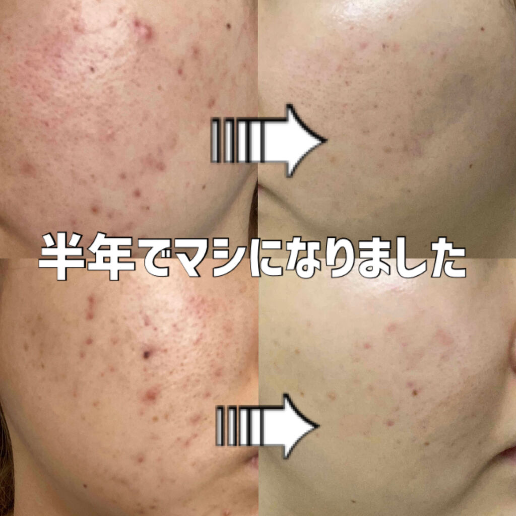 クリンダマイシン酸エステルゲル1%「サワイ」(医薬品)/sawai/その他を使ったクチコミ（2枚目）