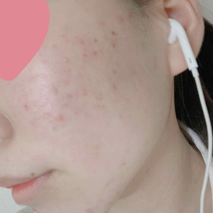 アボカド on LIPS 「閲覧注意です!!!今高校生なんですけど、ニキビが治りません😭ど..」(2枚目)