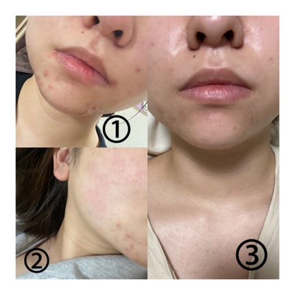 大人のニキビ対策 薬用美白クリーム/肌美精/フェイスクリームを使ったクチコミ(3枚目)