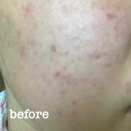 バイオイル/バイオイル/フェイスオイルを使ったクチコミ(2枚目)