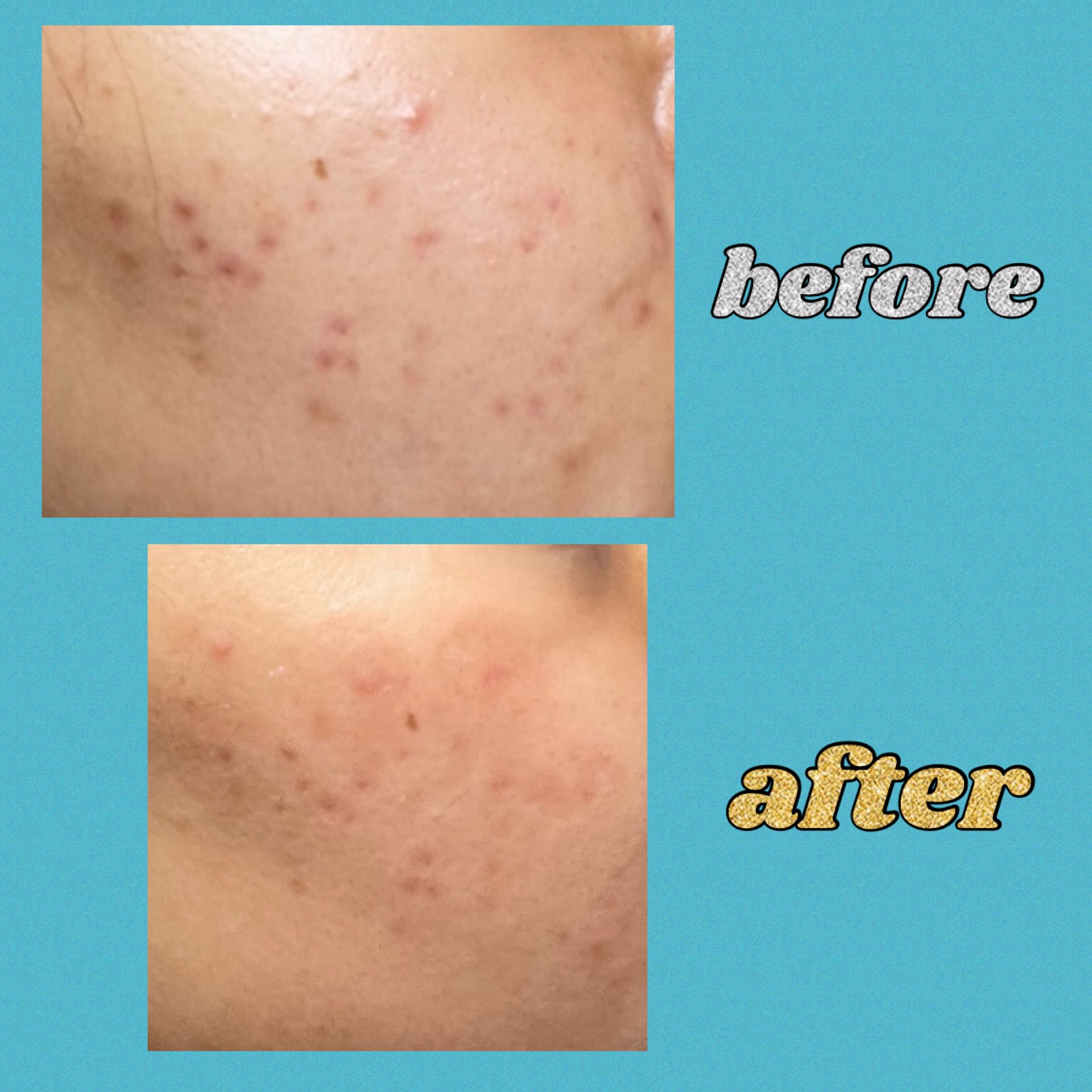 ニキビあとケアジェル/アットノン/その他スキンケアを使ったクチコミ（2枚目）