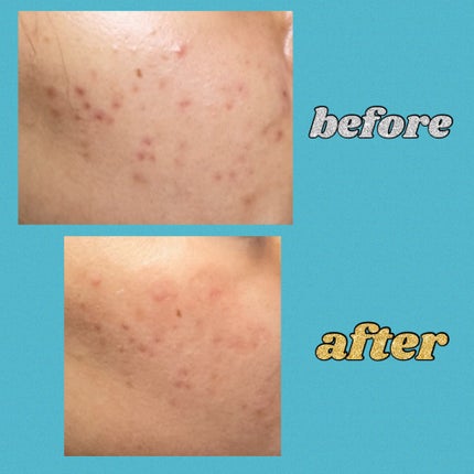 ニキビあとケアジェル/アットノン/その他スキンケアを使ったクチコミ(2枚目)