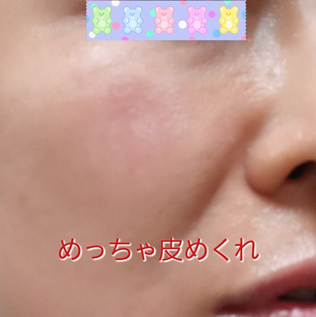 トレチノインジェル/A-Ret/美容液を使ったクチコミ(2枚目)