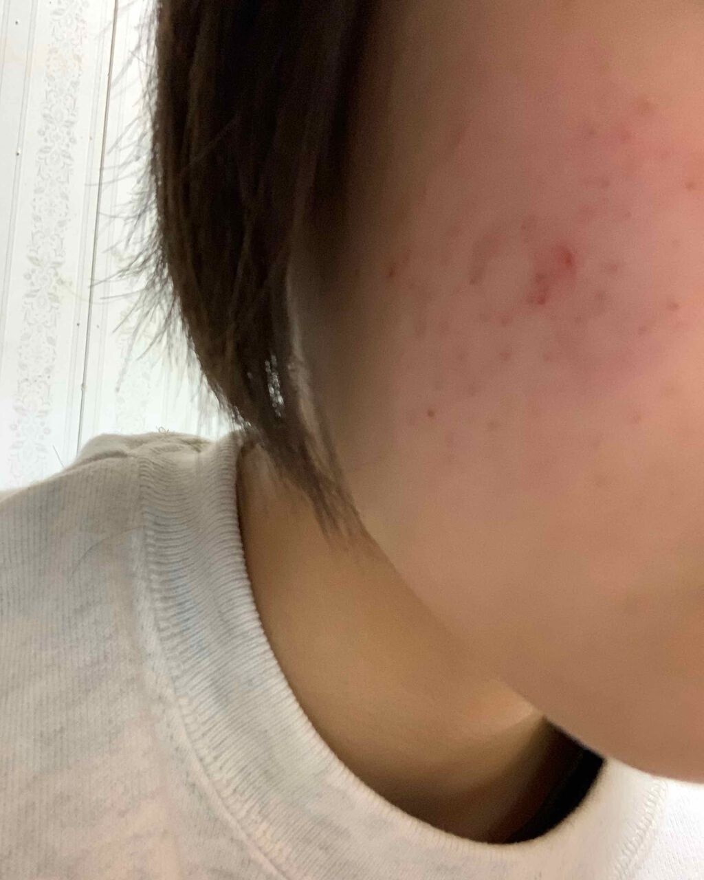 スキンケア洗顔料 薬用アクネケア/ビオレ/洗顔フォームを使ったクチコミ（3枚目）