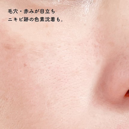 レッドアクネピーリングセラム/MEDICUBE/美容液を使ったクチコミ(8枚目)