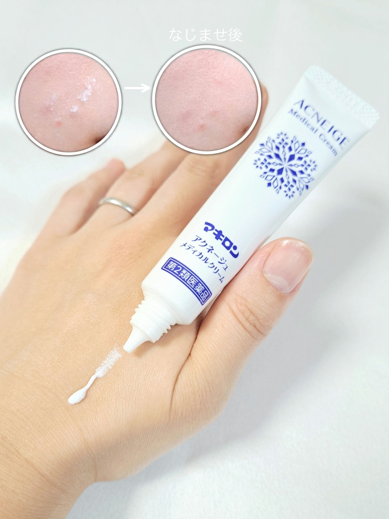 マキロン アクネージュ メディカルクリーム (医薬品) /マキロン/その他を使ったクチコミ(1枚目)