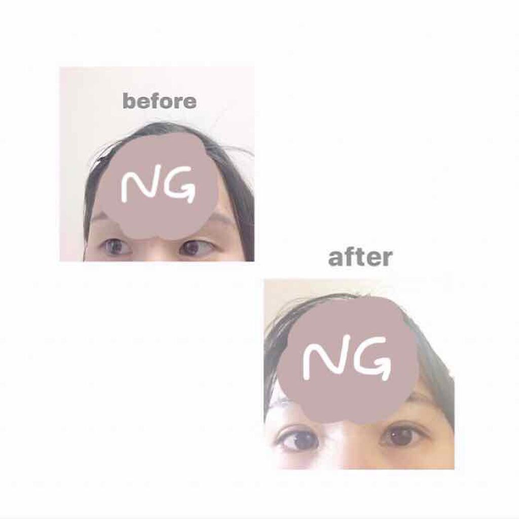 わかば on LIPS 「突然ですが整形してきました!これはダウンタイム用の記録です✨ず..」(2枚目)