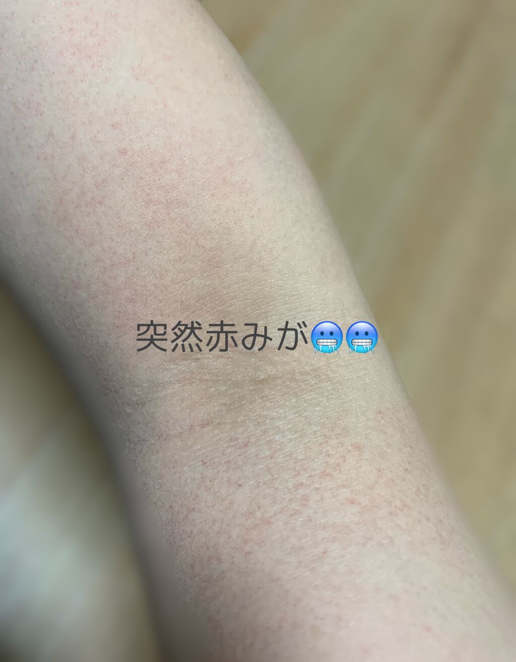 光脱毛器 VIO/Sarlisi/家庭用脱毛器を使ったクチコミ(5枚目)