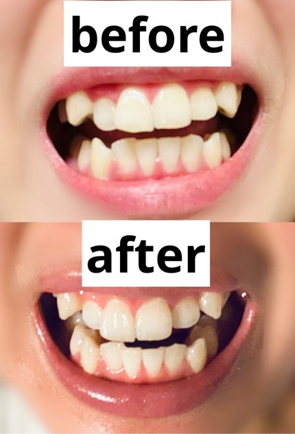 ã¢ãã¬ãŒããã¬ããª/ã¢ãã¬ãŒã/æ¯ç£šãç²ã䜿ã£ãã¯ãã³ãïŒ2æç®ïŒ