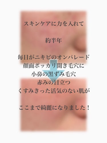 ちー汰む(( on LIPS 「🌷成長記録🌷※写真は全て入浴後スキンケア前の肌三日坊主の私が絶..」（1枚目）