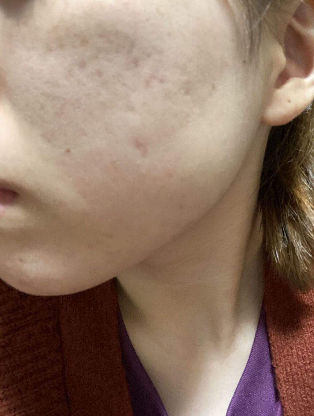 薬用アクネホワイトニング ジェル（部分用美容液）/DHC/美容液を使ったクチコミ（3枚目）