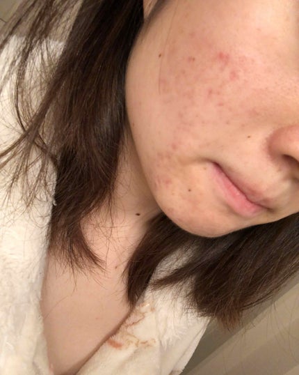 マンスリースキンケアプログラム(旧)/APEX/スキンケアキットを使ったクチコミ(3枚目)