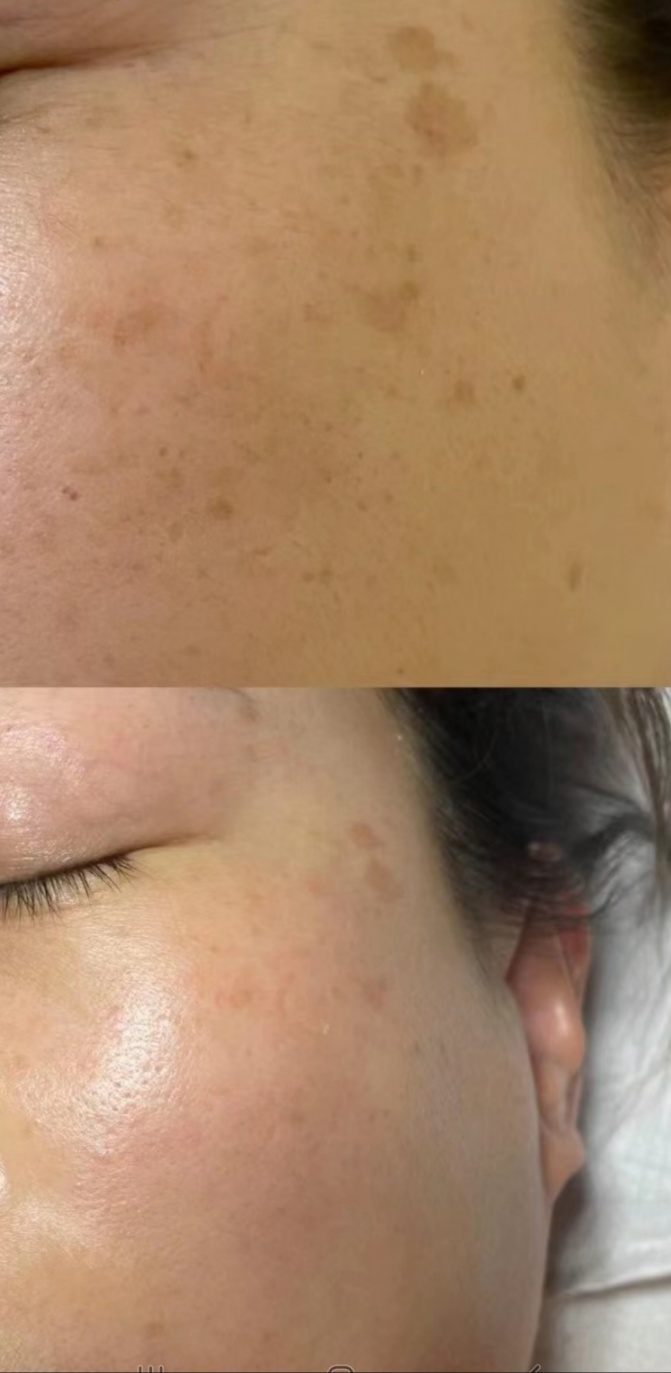 メラティノンクリーム/DERMA RESEARCH/フェイスクリームを使ったクチコミ（2枚目）