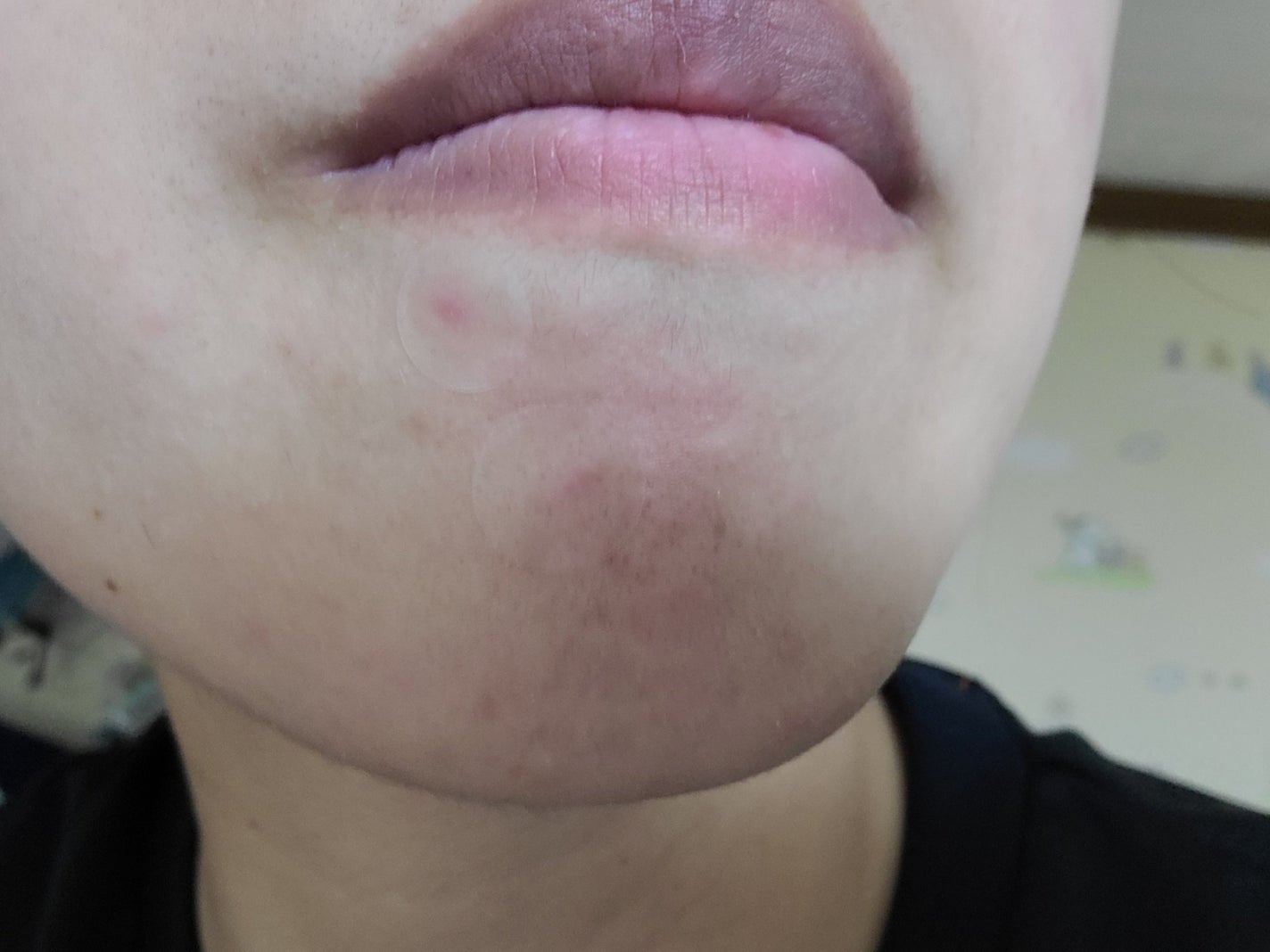 極薄透明パッチ nikipa!/金冠堂/にきびパッチを使ったクチコミ(2枚目)