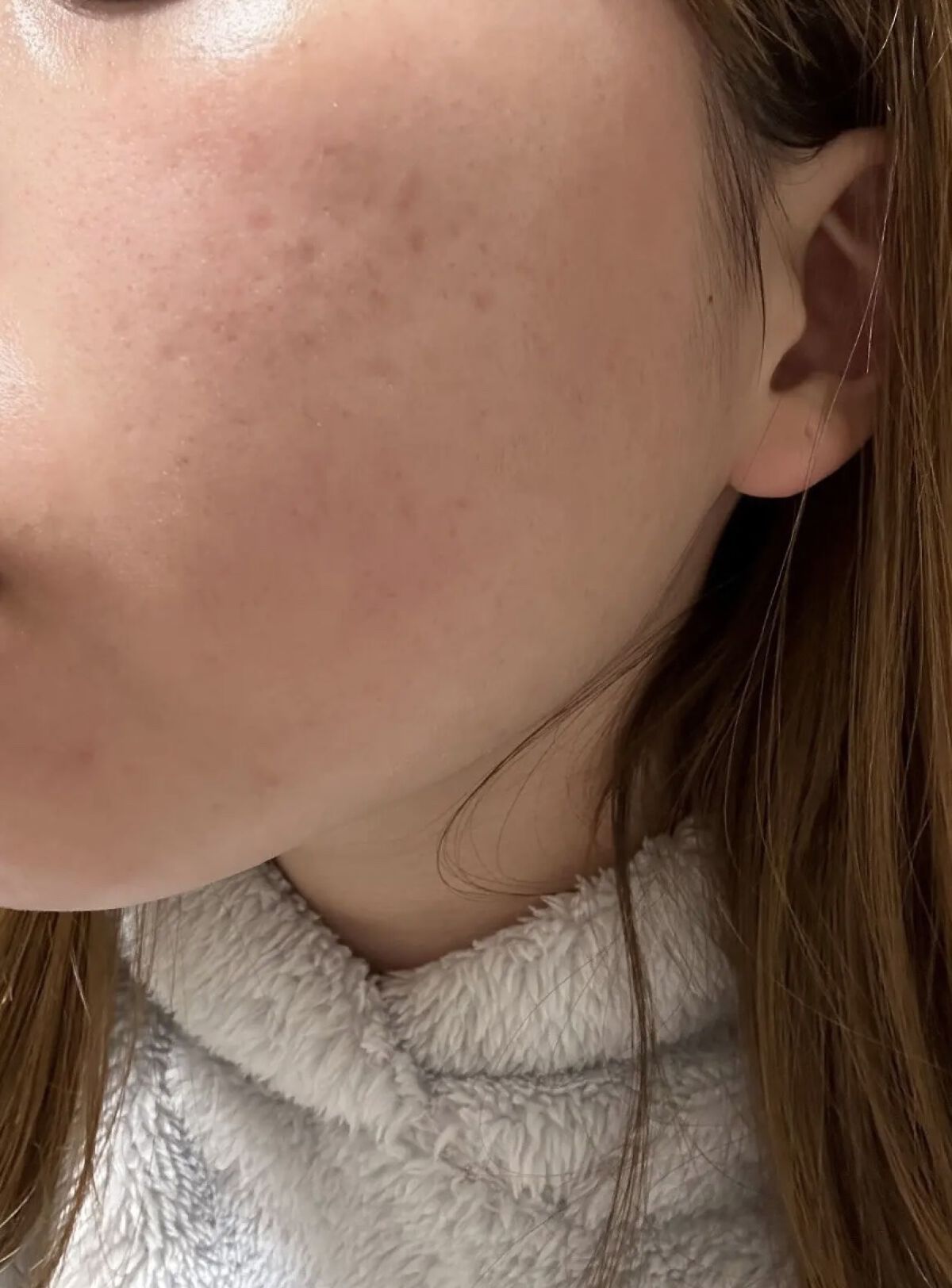 ティーツリーバイオーム ブレミッシュシカアンプル/MEDIHEAL/美容液を使ったクチコミ（3枚目）