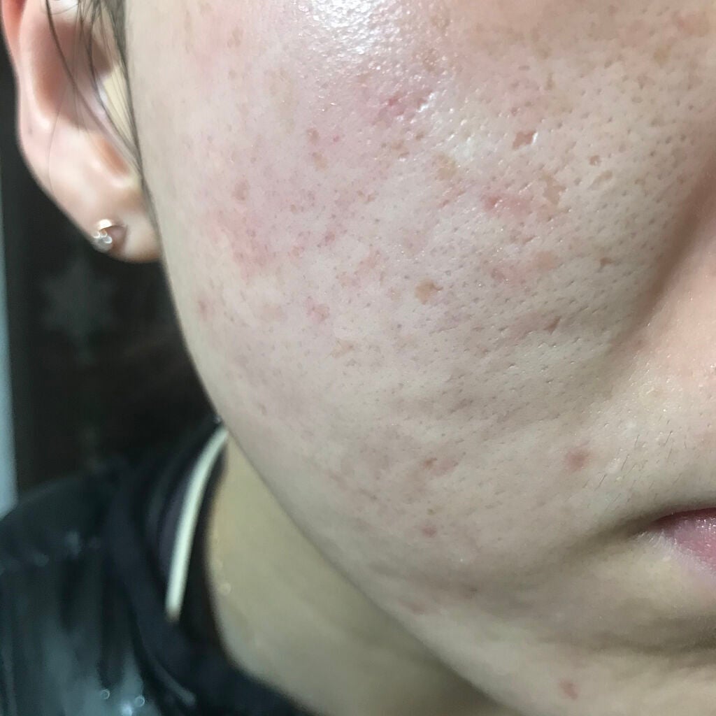 ドクタージャルト シカペア リカバー (第2世代)/Dr.Jart+/フェイスクリームを使ったクチコミ(3枚目)