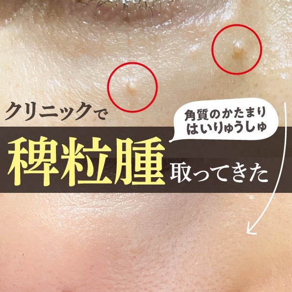 ピュアベール(医薬品)/プロペト/その他を使ったクチコミ(1枚目)