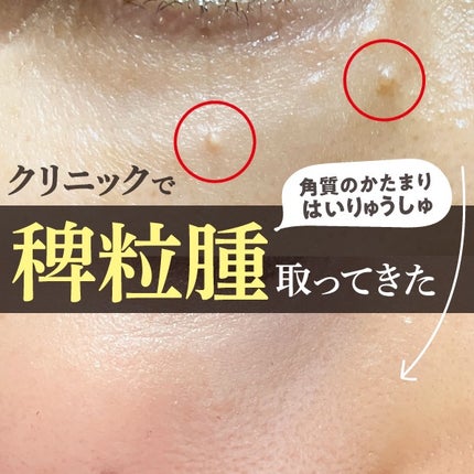 ピュアベール(医薬品)/プロペト/その他を使ったクチコミ(1枚目)