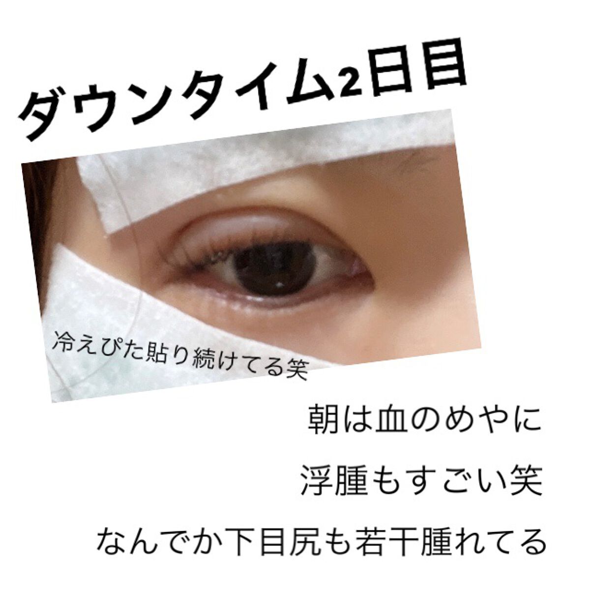 二重整形/その他を使ったクチコミ（1枚目）