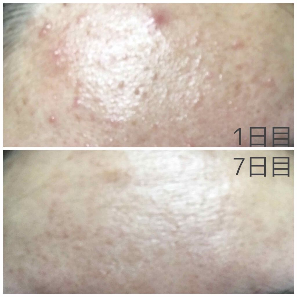 かな on LIPS 「アキュテインを飲み始めて7日目です。今日新しいニキビができまし..」(3枚目)