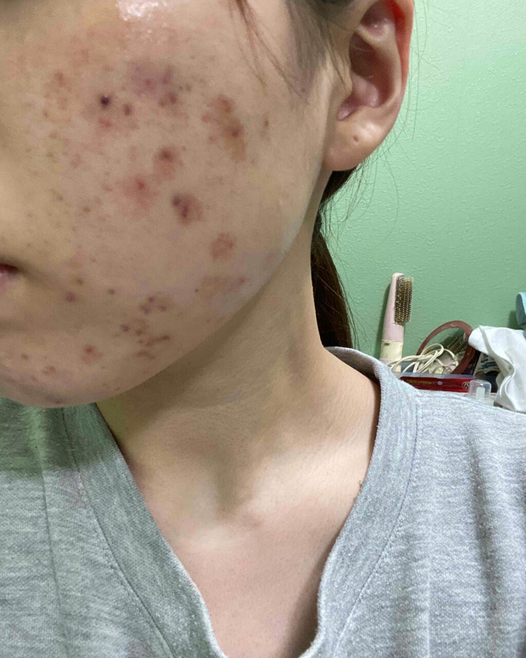 テラ・コートリル 軟膏(医薬品)/ジョンソン・エンド・ジョンソン/その他を使ったクチコミ(4枚目)