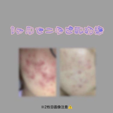 薬用 しみ 集中対策 美容液/メラノCC/美容液を使ったクチコミ（1枚目）