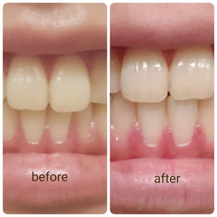 アパガードプレミオ/アパガード/歯磨き粉を使ったクチコミ(1枚目)